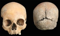 約1100年前の少女の頭蓋骨