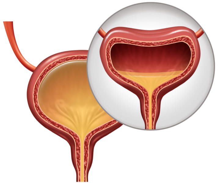 膀胱に溜まった尿による組織の伸縮。