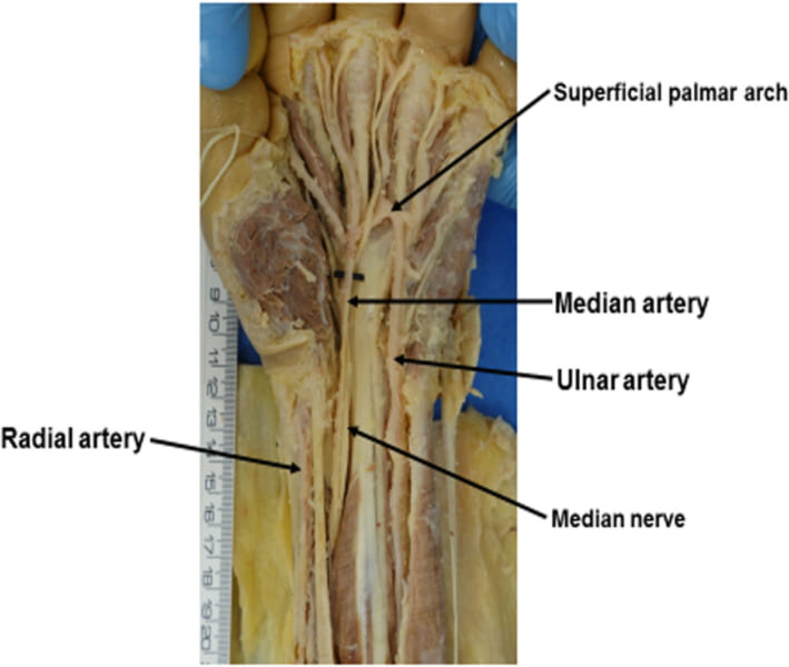2つの動脈の間に正中動脈（median artery）が残っている場合も