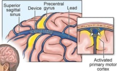 Stentrodeが脳領域で固定され、神経情報を読み取る