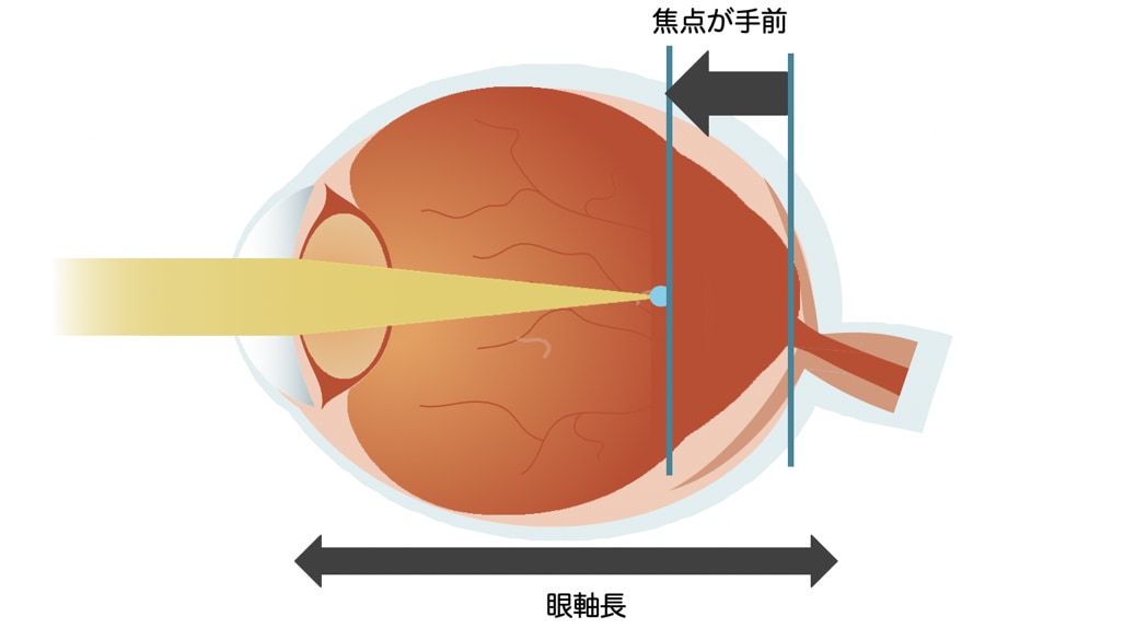 近視は眼軸長が伸長し、網膜上でピントが合わなくなることが原因