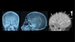 起きたまま脳に電極を刺す手術が行われ強迫性障害を治療することに成功！　左2枚は脳深部刺激療法（DBS）の代表的な画像で、右の1枚は別タイプのEEGと呼ばれる脳の刺激法