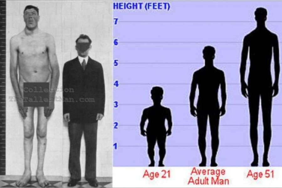 成人後に身長が1メートルも伸びる⁈ 人類で唯一「小人症」と「巨人症」を両方経験した人物とは