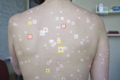 ニューラルネットワークを使用して、皮膚がんをより効率的に検出する