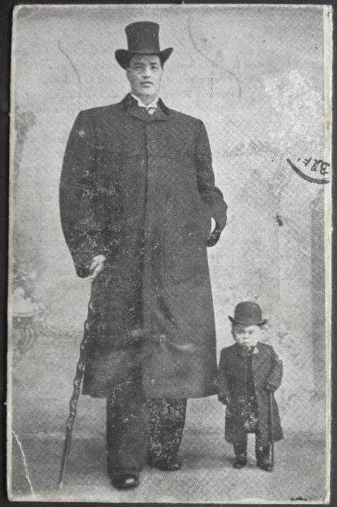 成人後のアダム（左）、右は小人症の人
