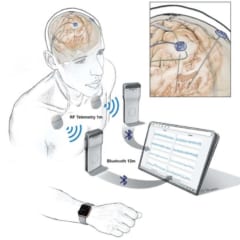 脳活動をリモートで記録・監視できるデバイスが開発される