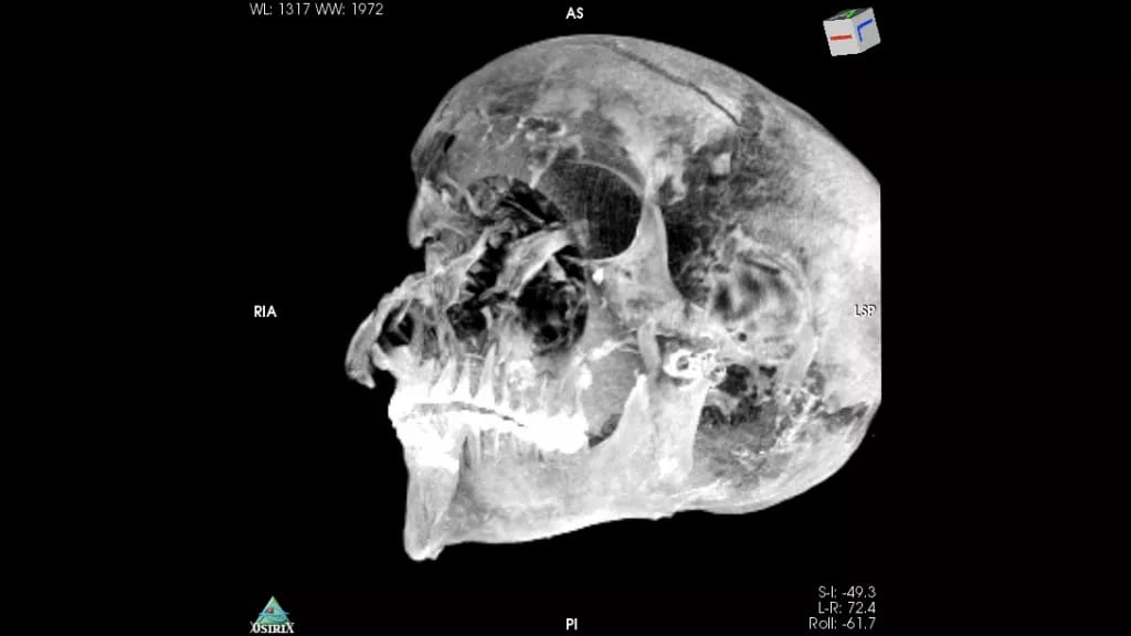 八つ裂きにされたファラオの頭蓋骨のCT画像