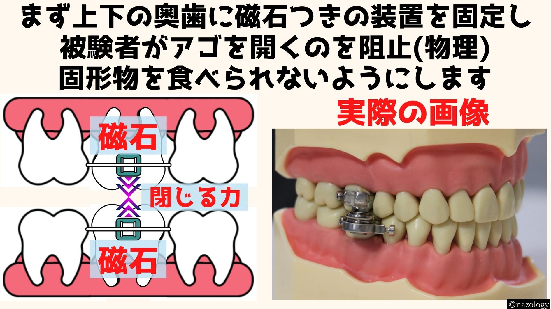 磁石で口を「物理的にロック」する減量装置が開発されるの画像 3/8