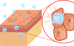 凍傷による「やけど」は細胞が凍りついて破裂する損傷