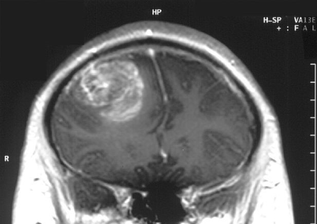 膠芽腫のMRI画像