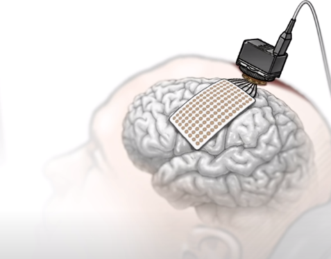 脳インプラントにより声帯の筋肉に送る信号をキャッチ