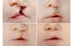 口唇口蓋裂の形成外科治療の過程を示した画像