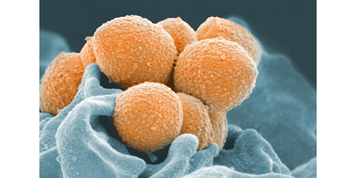 画像はA群レンサ球菌。今回のB群とは別の細菌。ヒト好中球（青）とA群レンサ球菌（オレンジ）の走査型電子顕微鏡画像