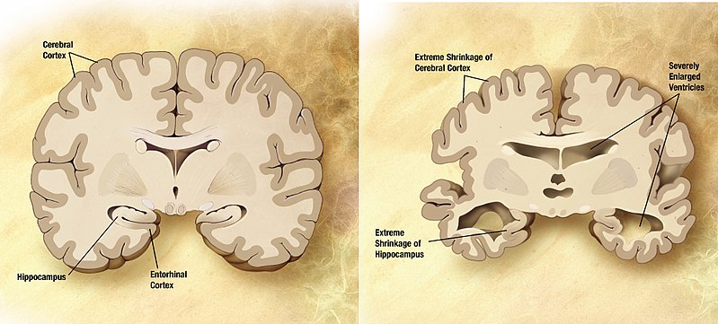 （左）通常の老人の脳, （右）アルツハイマー型認知症患者の脳