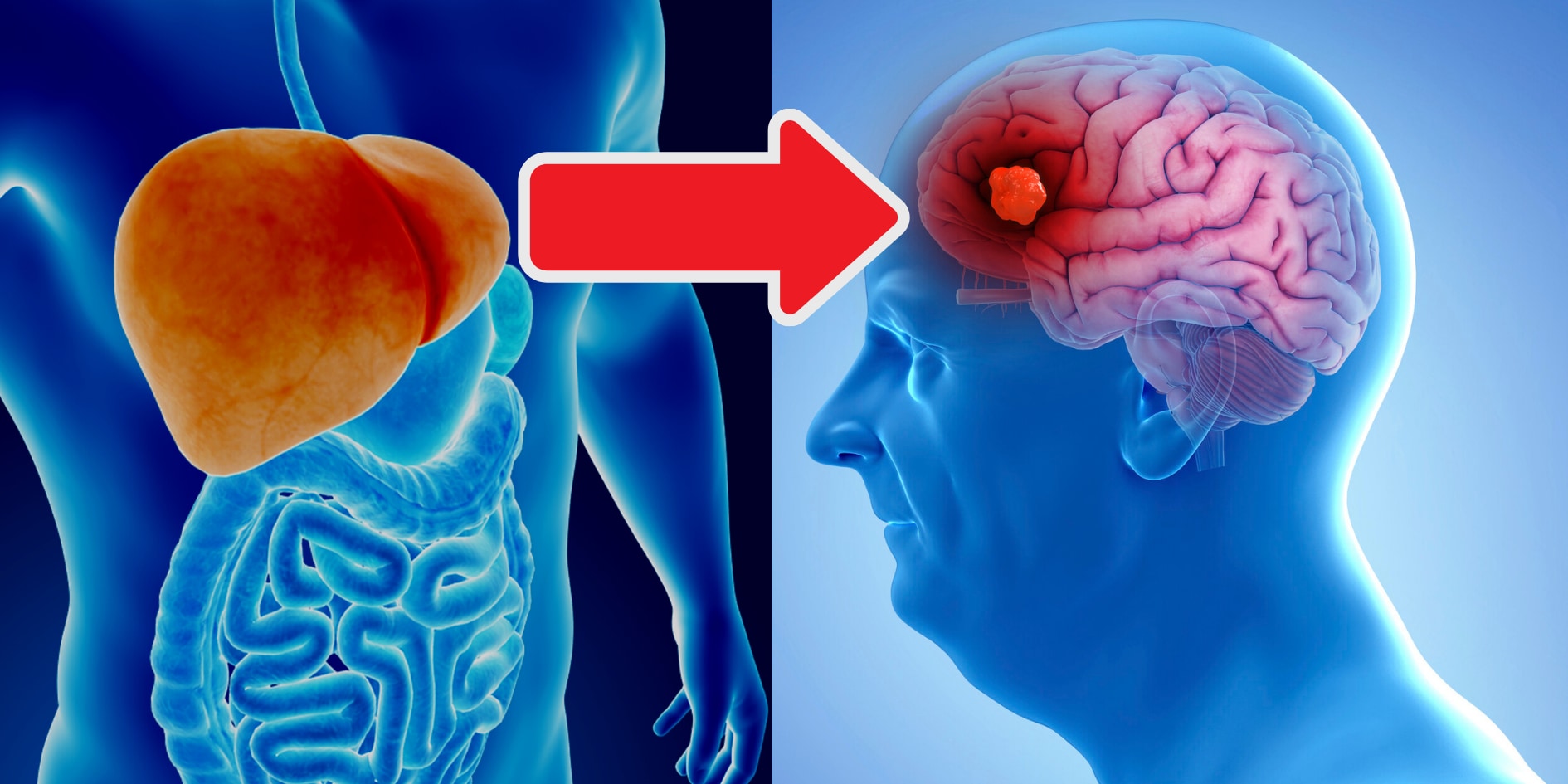 アルツハイマー病の原因「アミロイドβ」の発生源は肝臓の可能性！