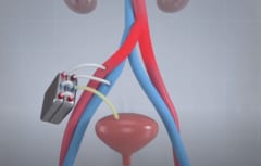人工腎臓移植時のイメージ