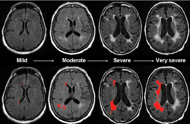 大脳白質病変のMRI画像と進行度