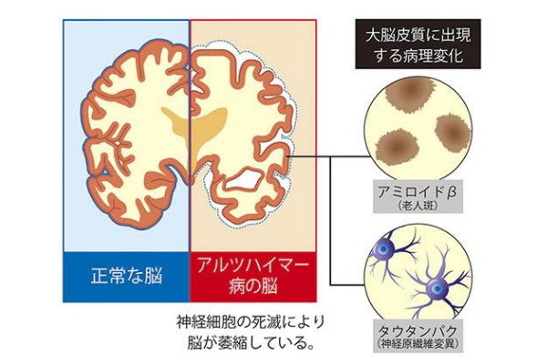 アルツハイマー病に見られる脳の変化にはアミロイドとタウタンパク質が関係している