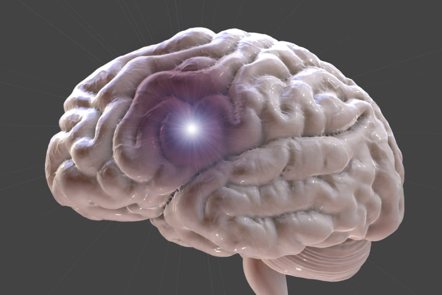 脳卒中による血腫を取り除く磁気制御のマイクロデバイス