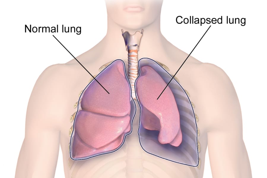 胸壁内に空気がたまり、肺を圧迫する