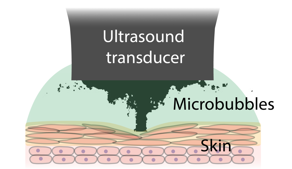 超音波によって小さな気泡（Microbubbles）が発生し、粘着剤を生体組織に押し込む