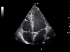 超音波画像診断よる「心臓の弁」のリアルタイム映像