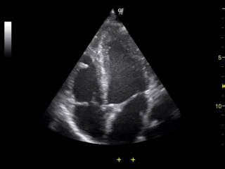超音波画像診断よる「心臓の弁」のリアルタイム映像