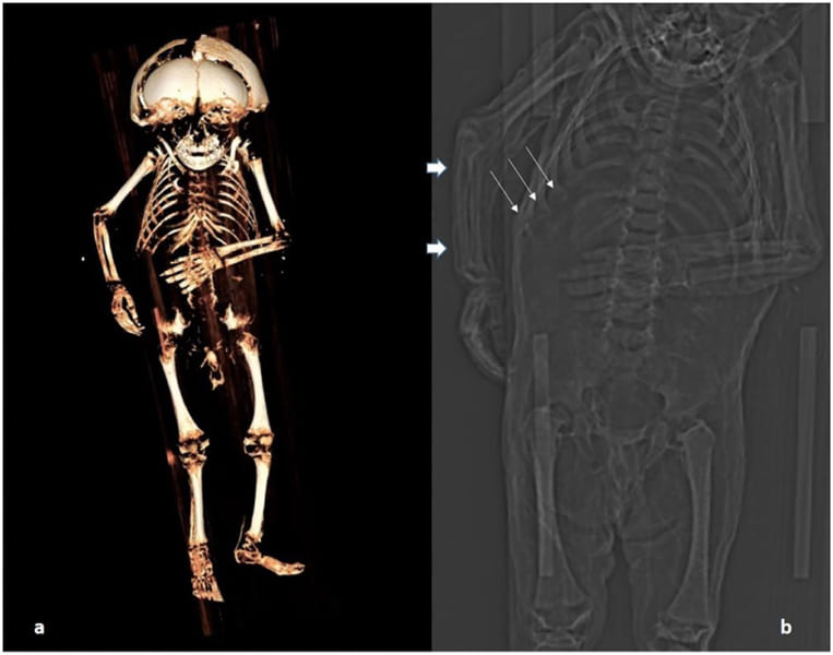 CTスキャンによる遺骨の分析（肋骨に奇形の痕跡が）
