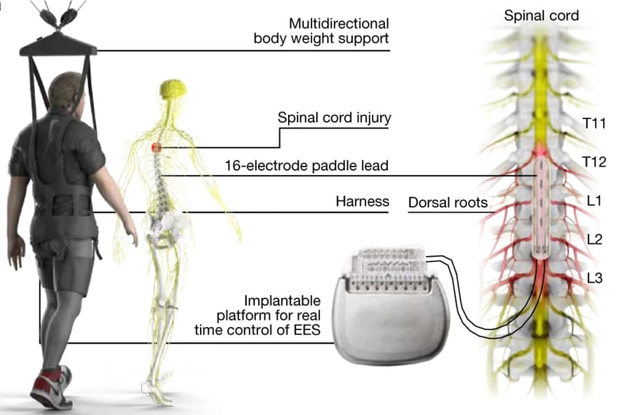 脊髄に電気刺激を与える「硬膜外電気刺激（EES）」