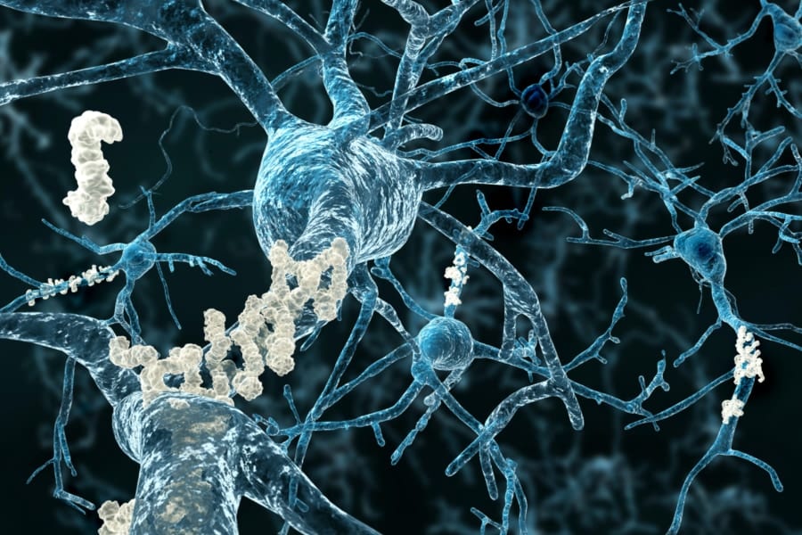 アミロイドβプラークが脳神経系に沈着するイメージ図