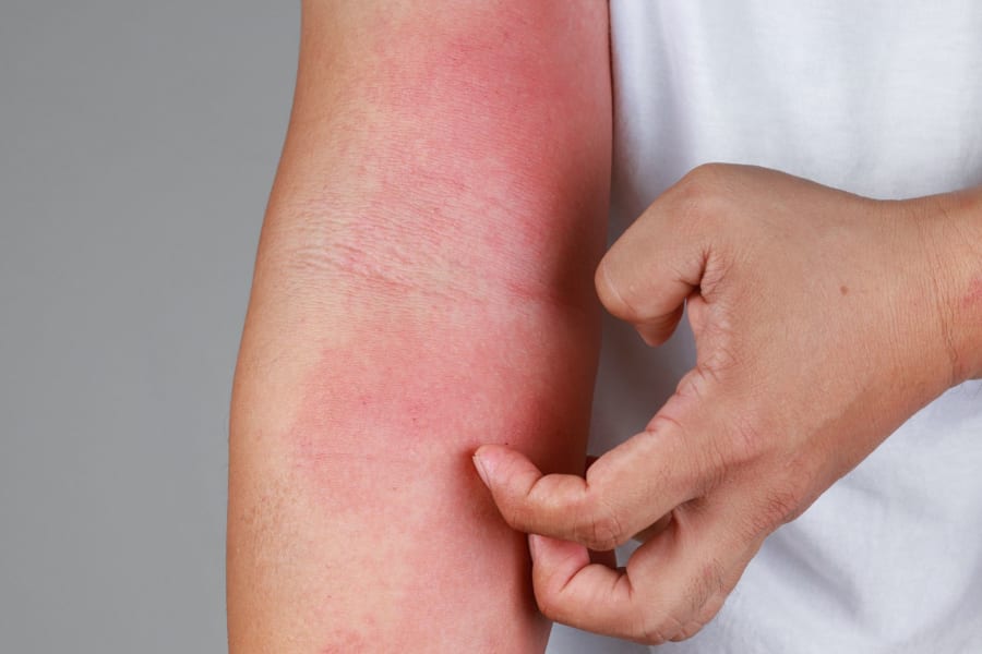 アトピー性皮膚炎の痒みの原因解明とその治療薬を発見