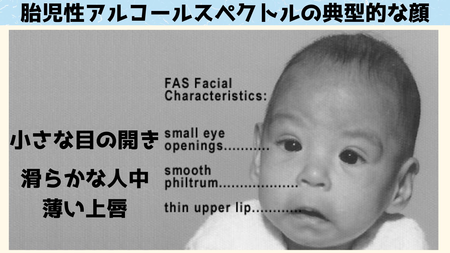 胎児性アルコールスペクトル障害の赤ちゃんの典型的な顔