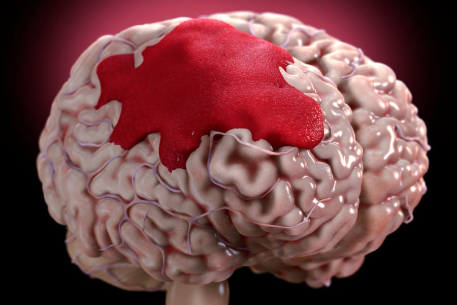 死亡率が極めて高い「脳を食べる」アメーバの特効薬が”既存の薬”から見つかる！