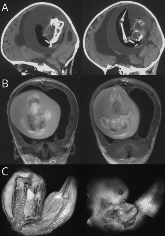 1歳女児の頭蓋内から「未発達の胎児」を摘出！非常に珍しい症例報告の画像