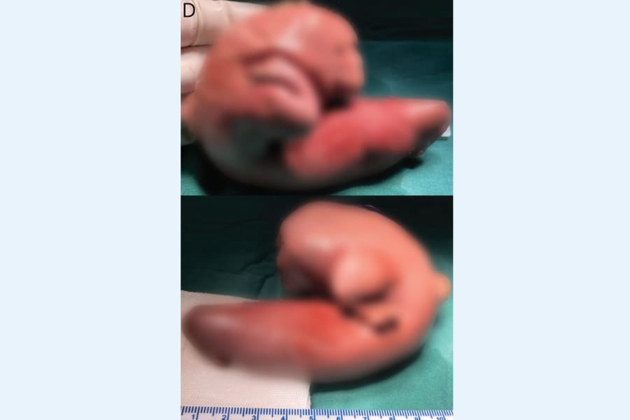 女児の頭蓋内から摘出された胎児の塊