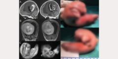 1歳女児の頭の中から「未発達の胎児」が摘出される（中国）