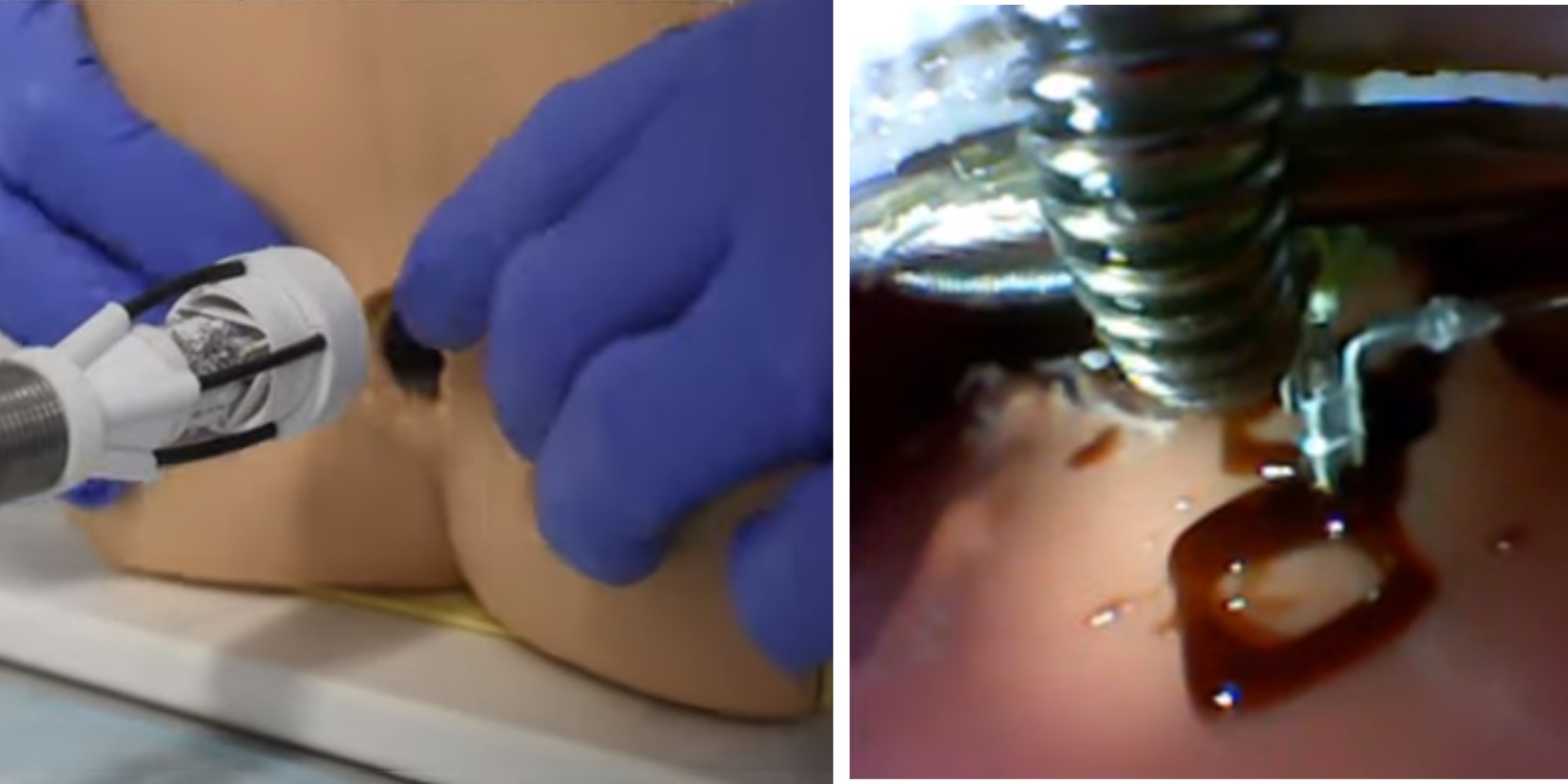 肛門から入れて臓器に直接3Dプリントするデバイス