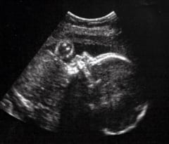 エコー（超音波）検査で撮影された胎児の画像