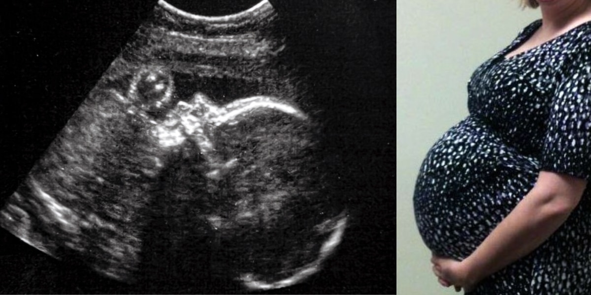 左：手術を受けた胎児、右：胎児の母親