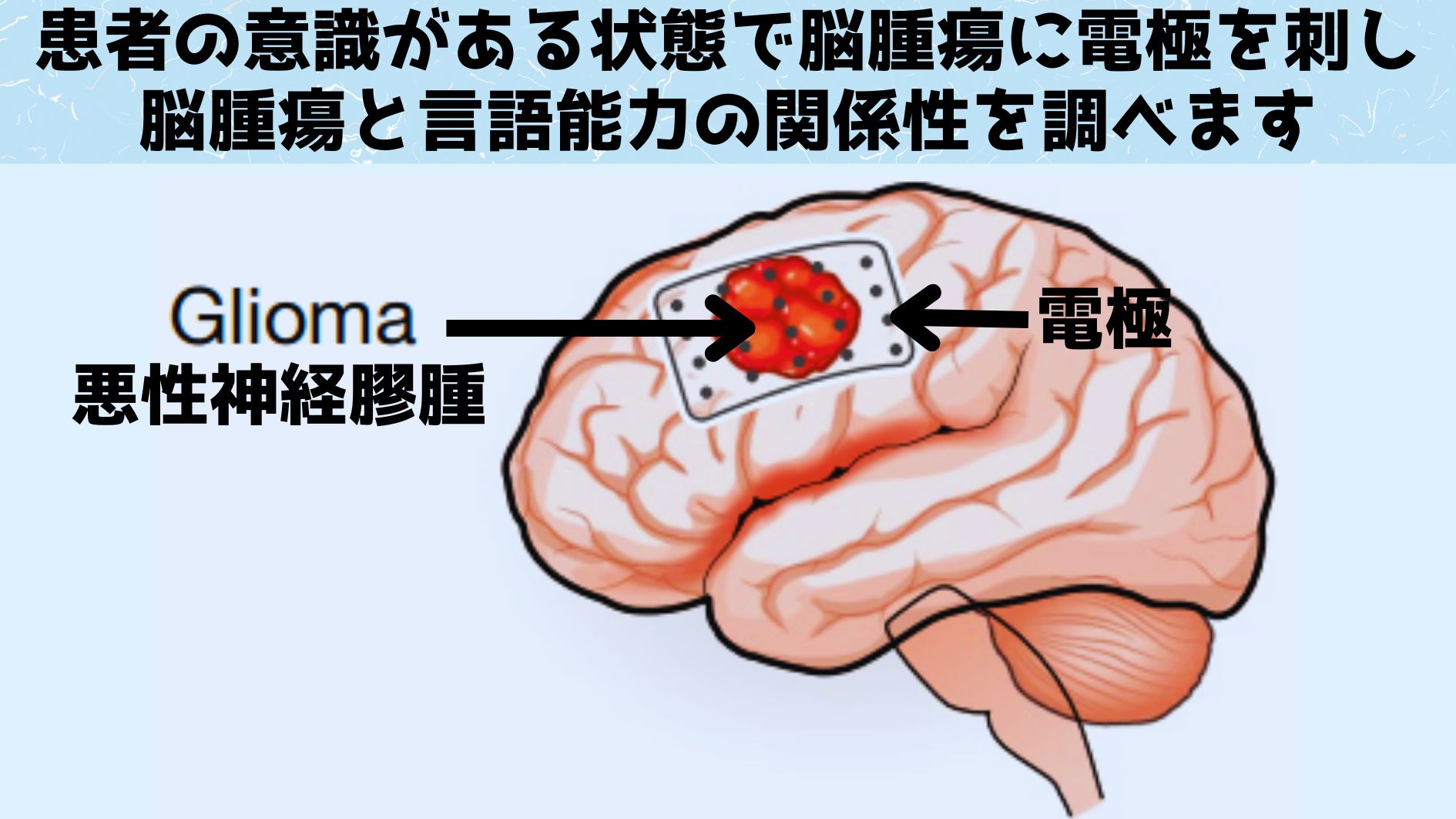 思考自体が脳腫瘍の増殖を促進していると判明！