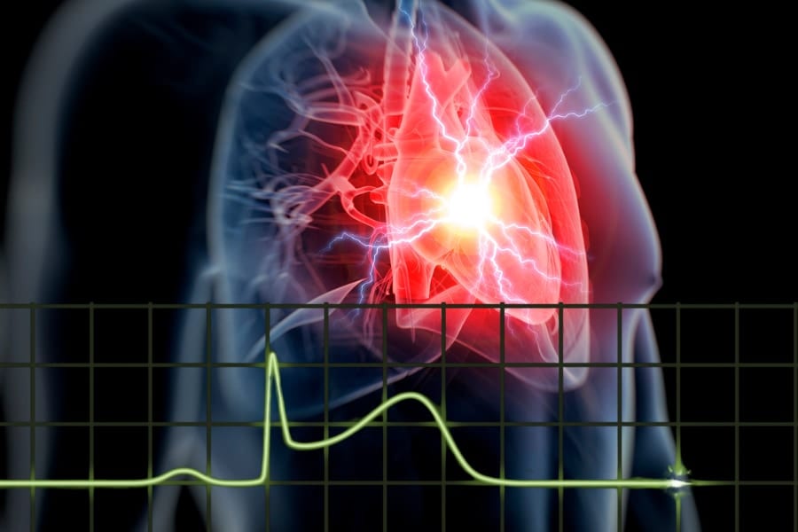 冠動脈が閉塞するST上昇型心筋梗塞（STEMI）