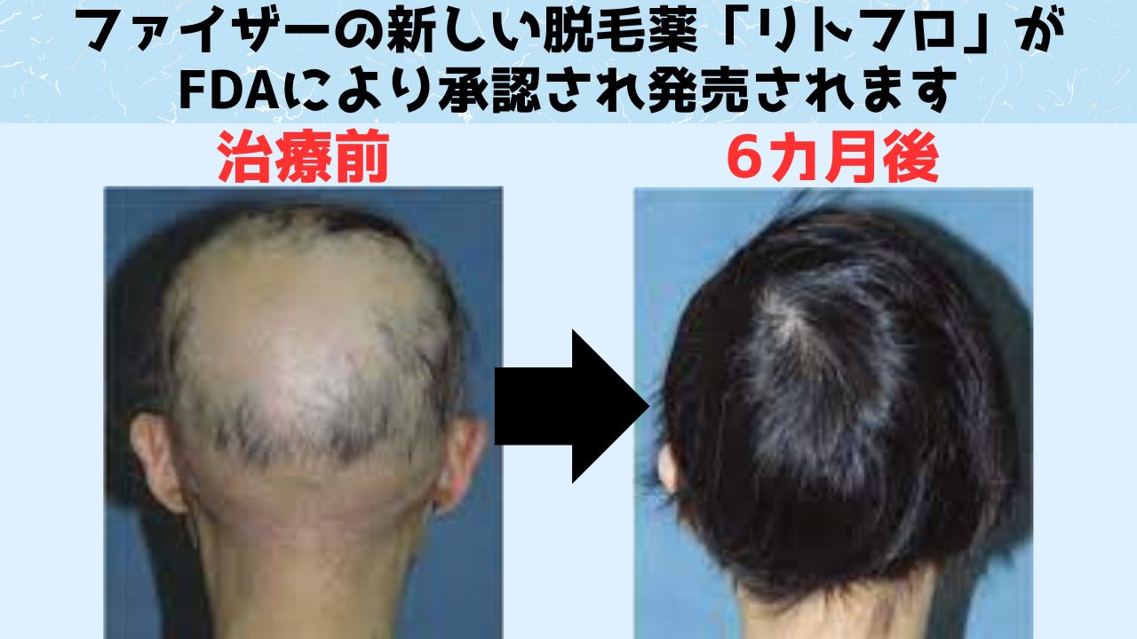 ファイザーの新しい脱毛症治療薬「リトフロ」がFDAにより承認！
