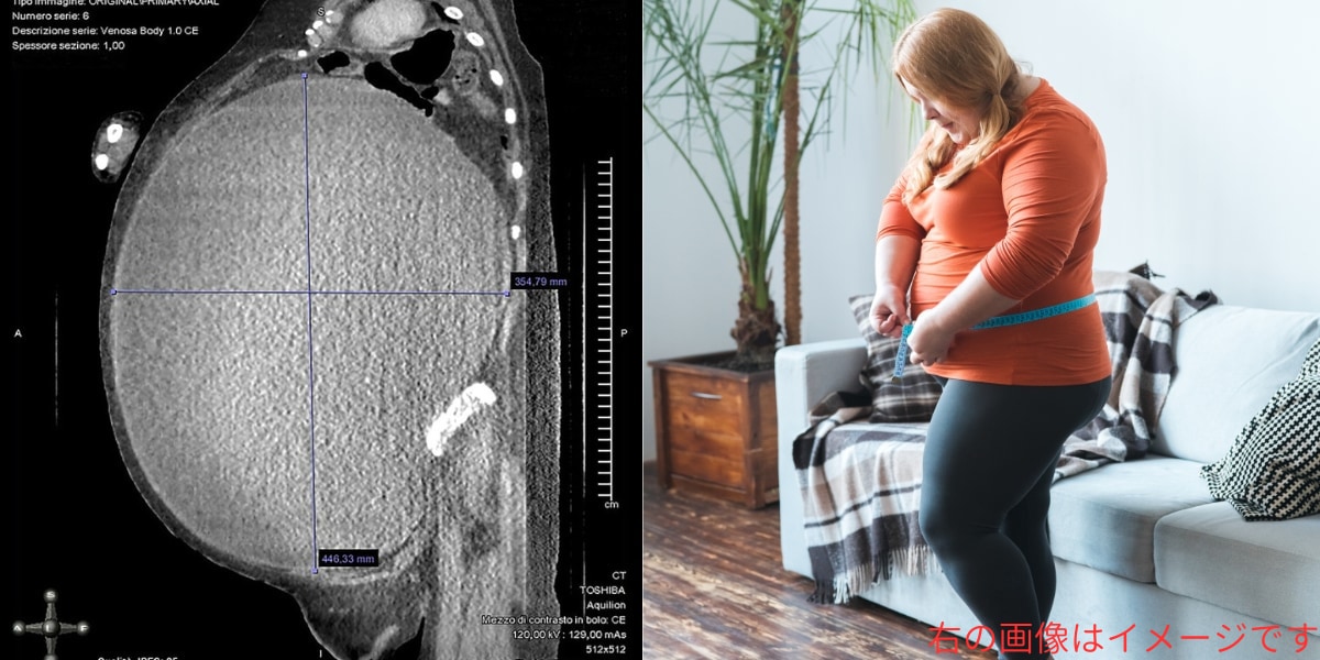 5キロの巨大腫瘍を「ただの太り過ぎ」と勘違いし放置してしまった女性