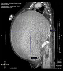 女性の巨大化した腫瘍のスキャン画像