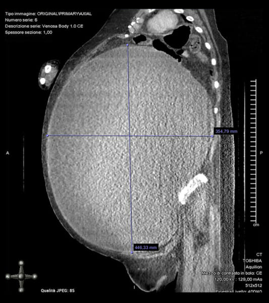 女性の巨大化した腫瘍のスキャン画像