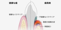 歯周病と健康な歯の比較