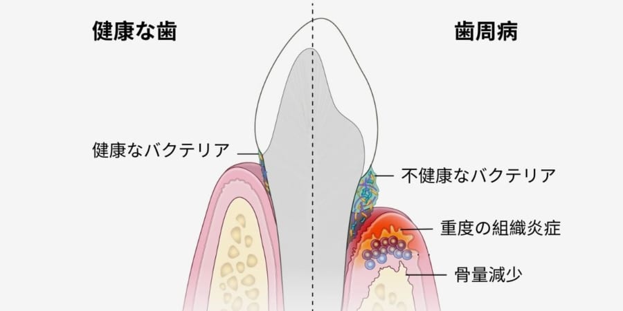 歯周病と健康な歯の比較