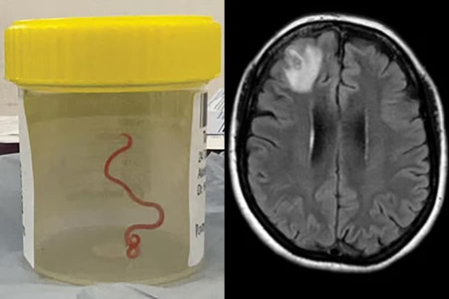 女性の脳から「ヘビに感染する寄生虫」を生きたまま摘出！世界初の症例