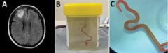 A:女性の脳に見られた病変（左上）、B・C：摘出された線虫（8cm）