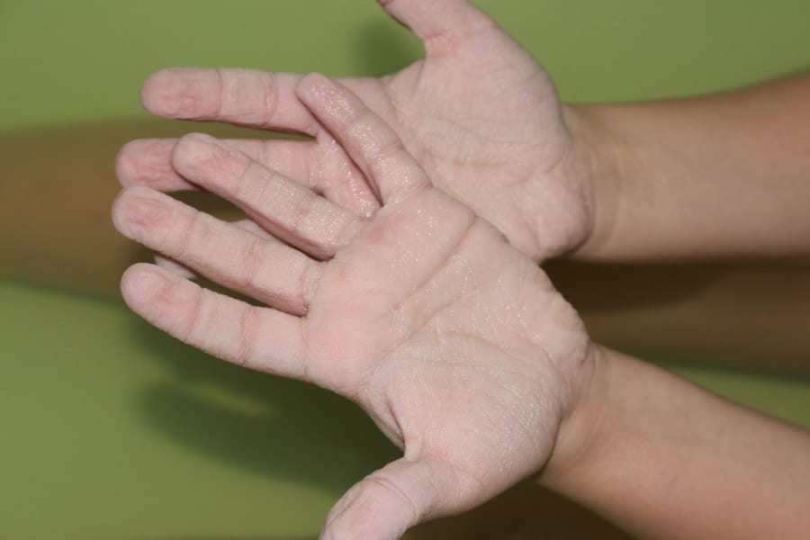 通常水に長く浸かると指にシワが寄るが、神経を損傷している人は異なる